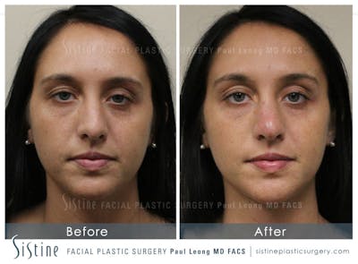 Restylane/ Juvederm Before & After Gallery - Patient 4891408 - Image 1