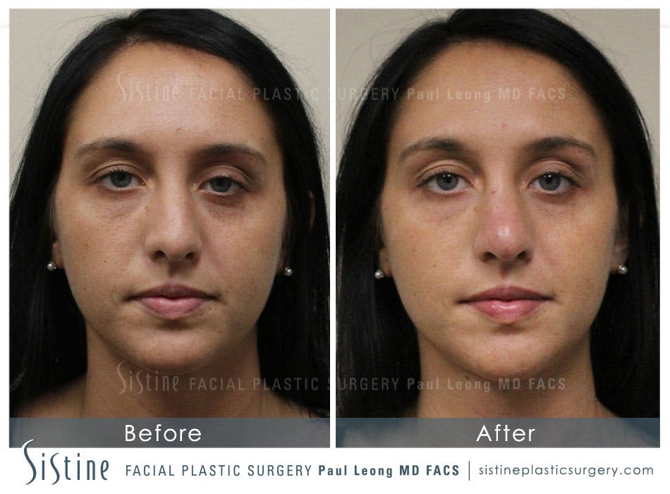 Restylane/ Juvederm Before & After Gallery - Patient 4891408 - Image 1