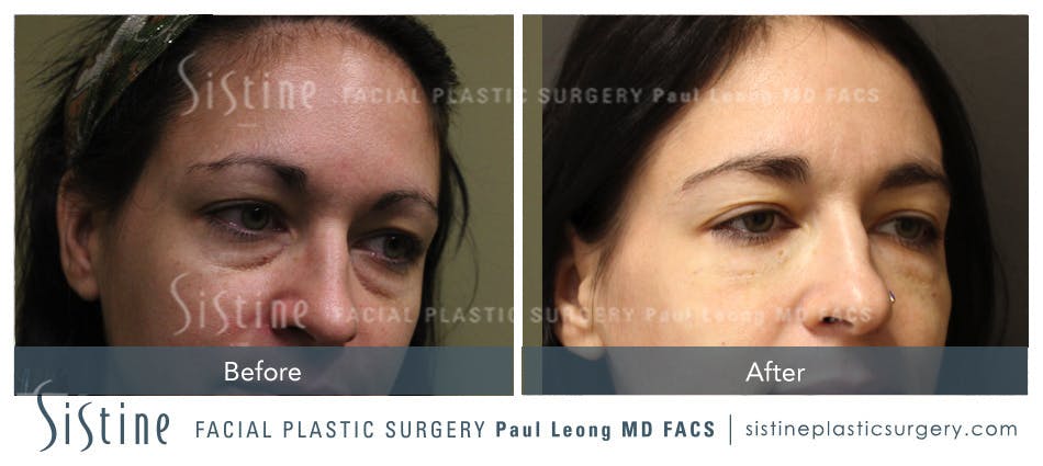 Tear Trough Correction Before & After Gallery - Patient 4891857 - Image 1