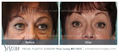 Tear Trough Correction Before & After Gallery - Patient 4891862 - Image 1