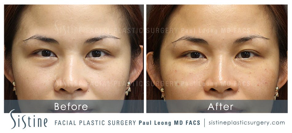 Tear Trough Correction Before & After Gallery - Patient 4892035 - Image 1