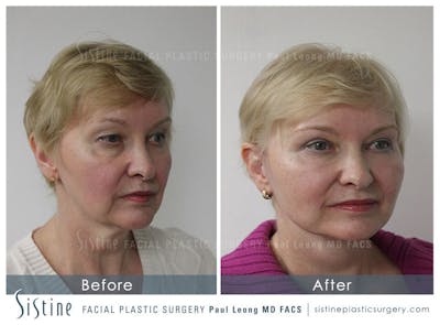 Tear Trough Correction Before & After Gallery - Patient 4892041 - Image 2