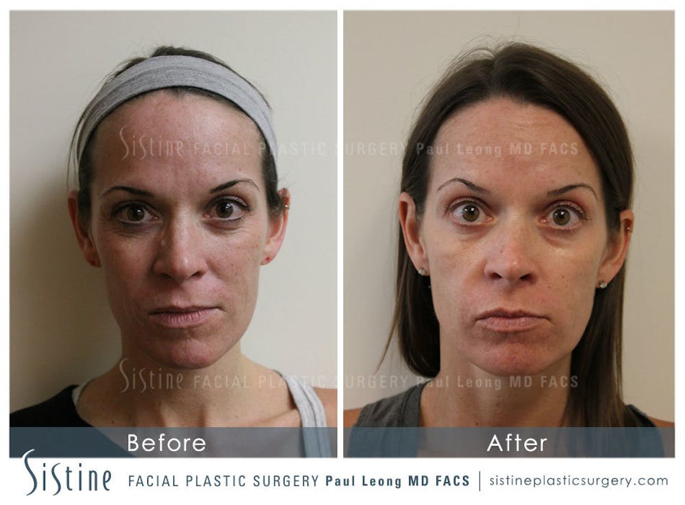 Phoenix CO2 Before & After Gallery - Patient 4893468 - Image 1