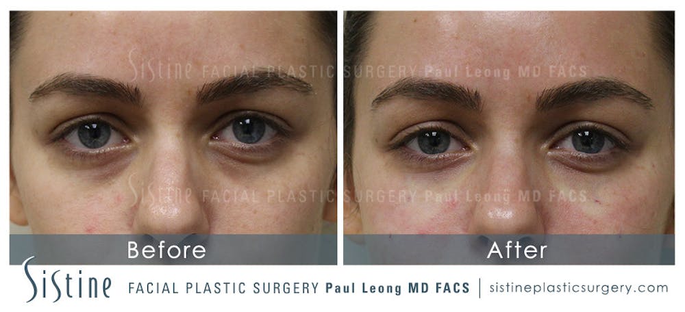 Restylane/ Juvederm Before & After Gallery - Patient 4891472 - Image 1