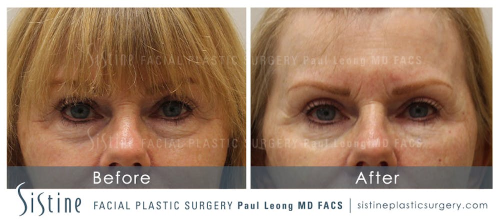 Restylane/ Juvederm Before & After Gallery - Patient 4891476 - Image 1
