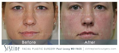 Restylane/ Juvederm Before & After Gallery - Patient 4891477 - Image 2