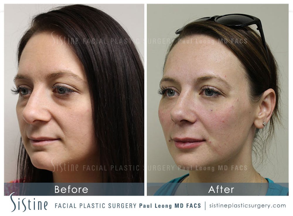 Restylane/ Juvederm Before & After Gallery - Patient 4891478 - Image 4