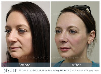 Restylane/ Juvederm Before & After Gallery - Patient 4891478 - Image 4
