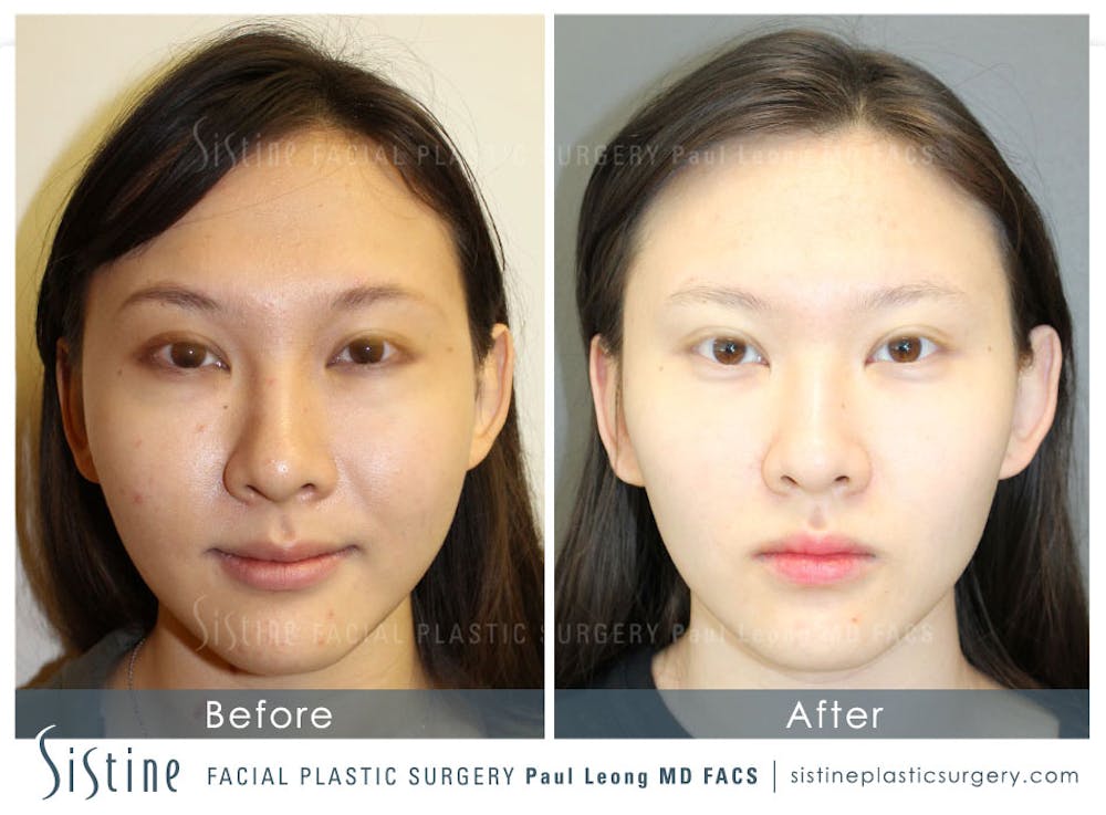 Restylane/ Juvederm Before & After Gallery - Patient 4891481 - Image 1