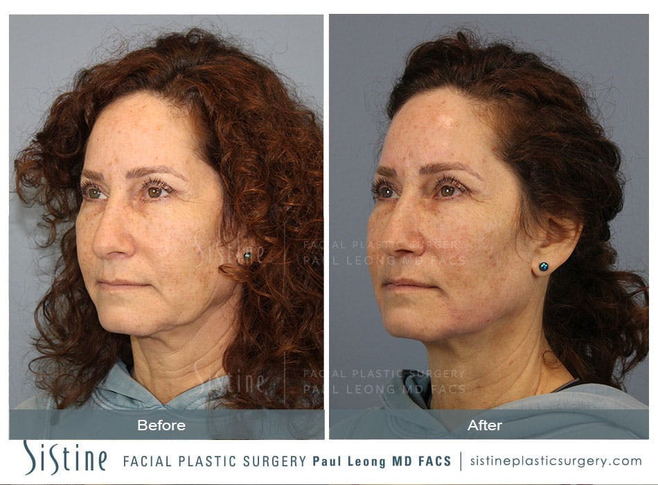 Jawline Slimming Before & After Gallery - Patient 96929189 - Image 2