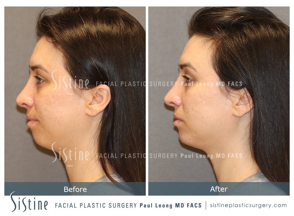 Restylane/ Juvederm Before & After Gallery - Patient 425231 - Image 2