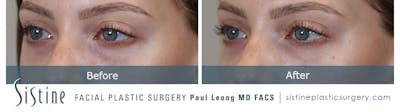Tear Trough Correction Before & After Gallery - Patient 153553 - Image 2