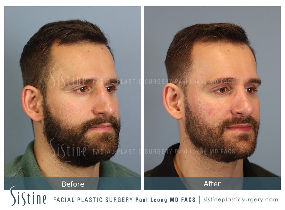 Rhinoplasty Before & After Gallery - Patient 161753 - Image 3