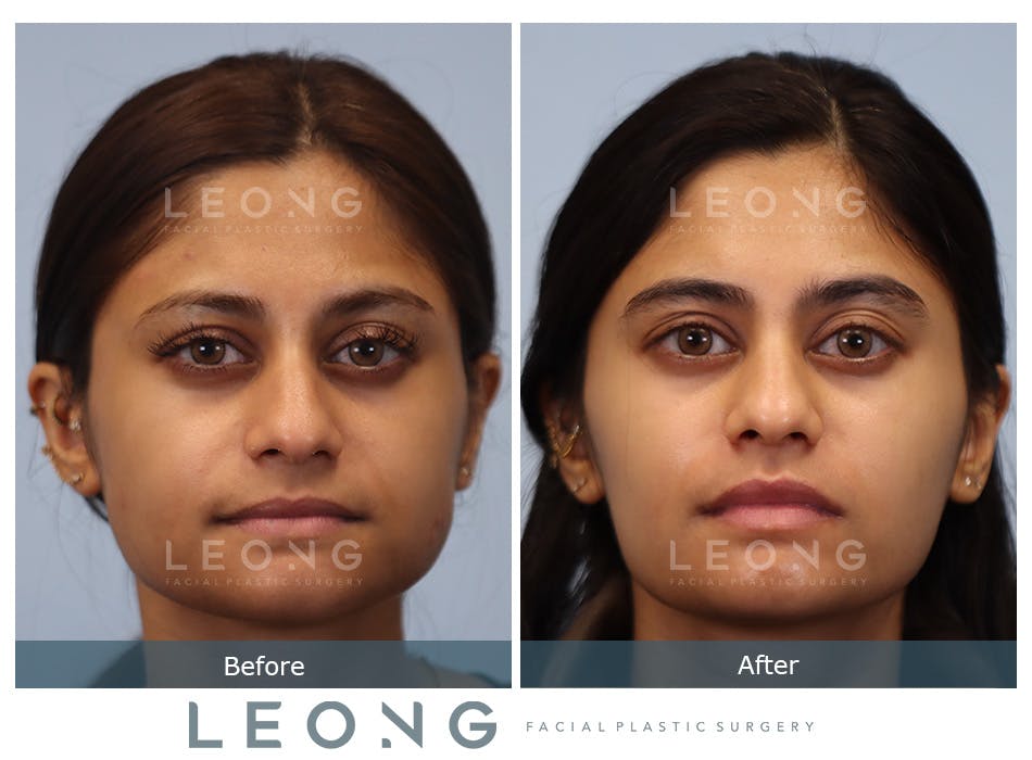 Jawline Slimming Before & After Gallery - Patient 304623 - Image 1