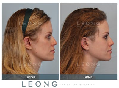 Sculptra® Before & After Gallery - Patient 4890976 - Image 4