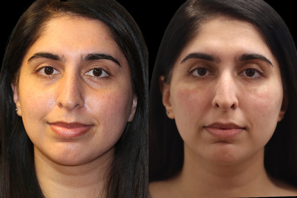 Tear Trough Correction Before & After Gallery - Patient 390631 - Image 1