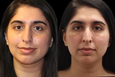 Tear Trough Correction Before & After Gallery - Patient 390631 - Image 1