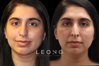 Tear Trough Correction Before & After Gallery - Patient 390631 - Image 1