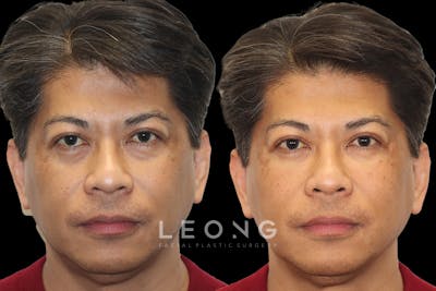 Tear Trough Correction Before & After Gallery - Patient 288110 - Image 1