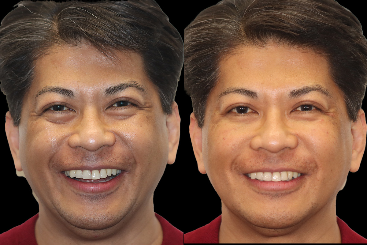 Tear Trough Correction Before & After Gallery - Patient 288110 - Image 2