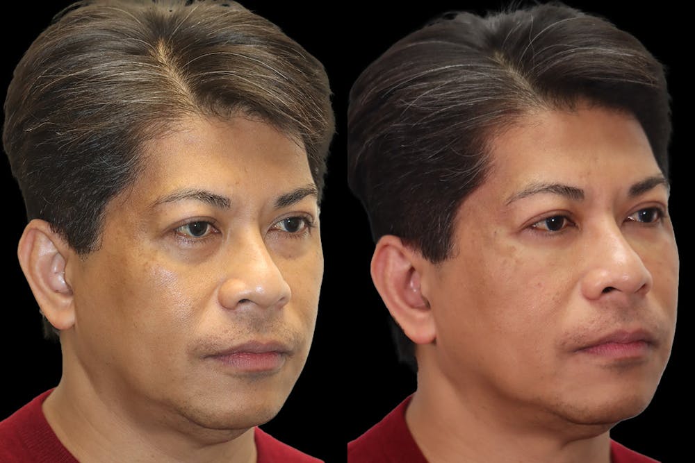 Tear Trough Correction Before & After Gallery - Patient 288110 - Image 3