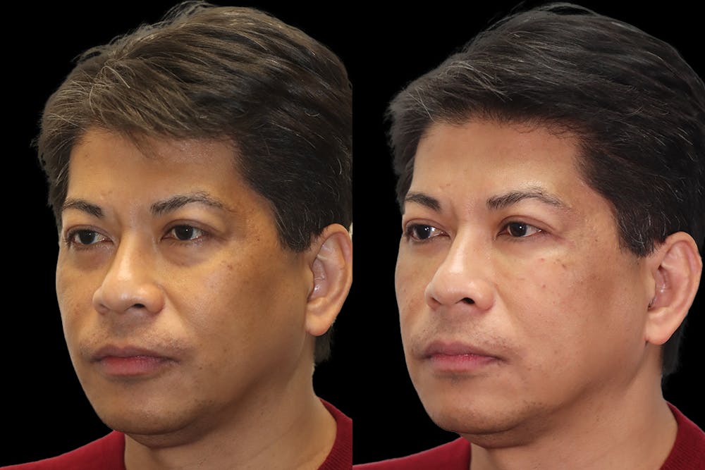 Tear Trough Correction Before & After Gallery - Patient 288110 - Image 4