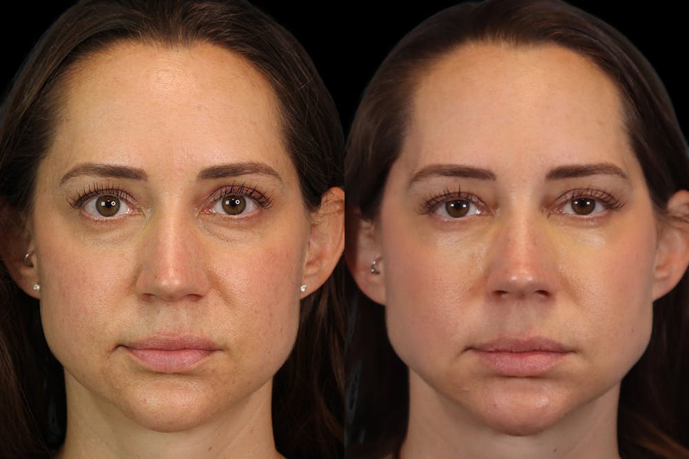 Tear Trough Correction Before & After Gallery - Patient 263355 - Image 1