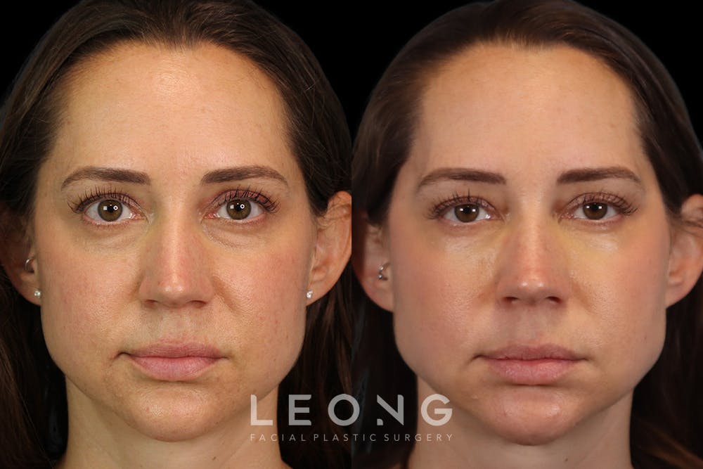 Tear Trough Correction Before & After Gallery - Patient 263355 - Image 1