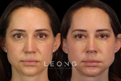 Tear Trough Correction Before & After Gallery - Patient 263355 - Image 1