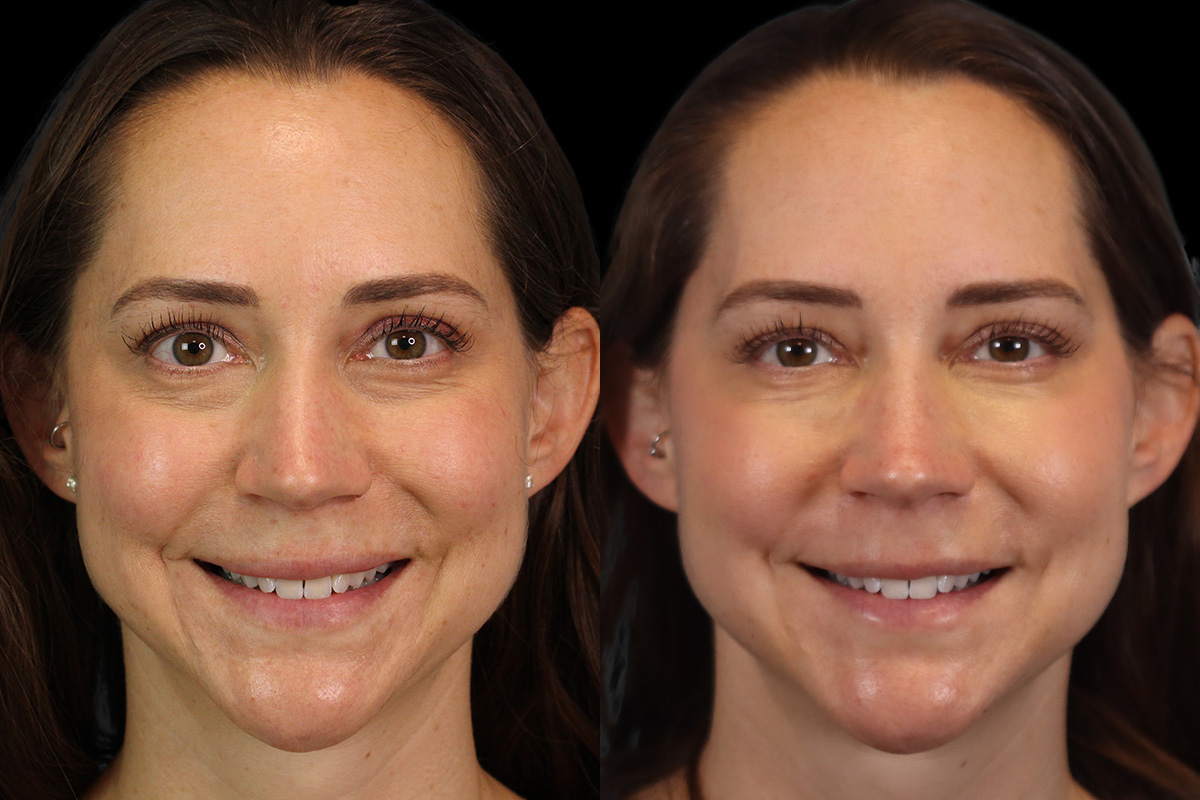 Tear Trough Correction Before & After Gallery - Patient 263355 - Image 2