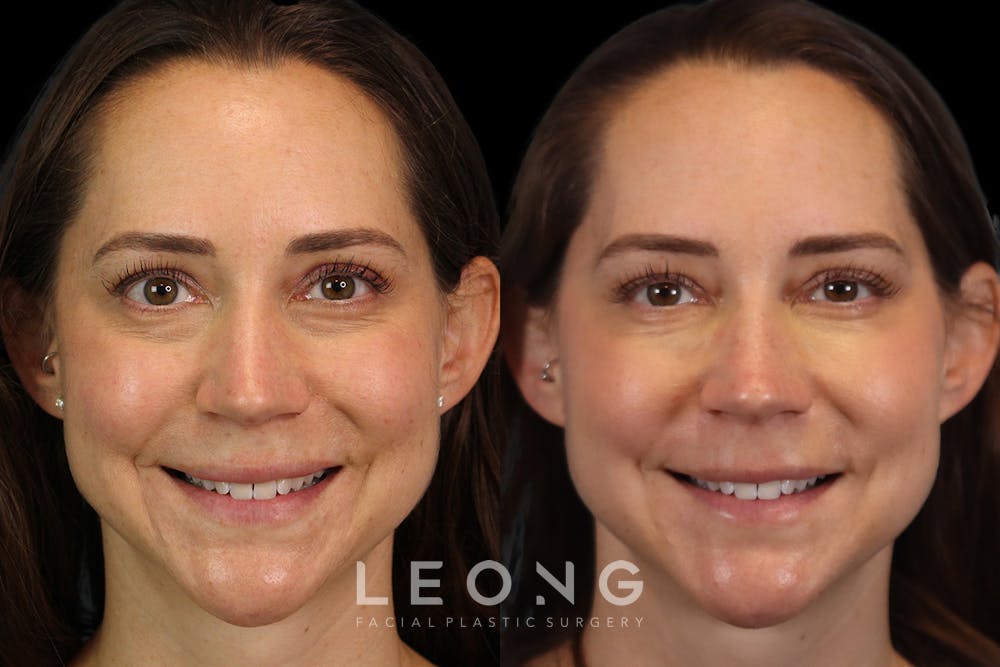 Tear Trough Correction Before & After Gallery - Patient 263355 - Image 2