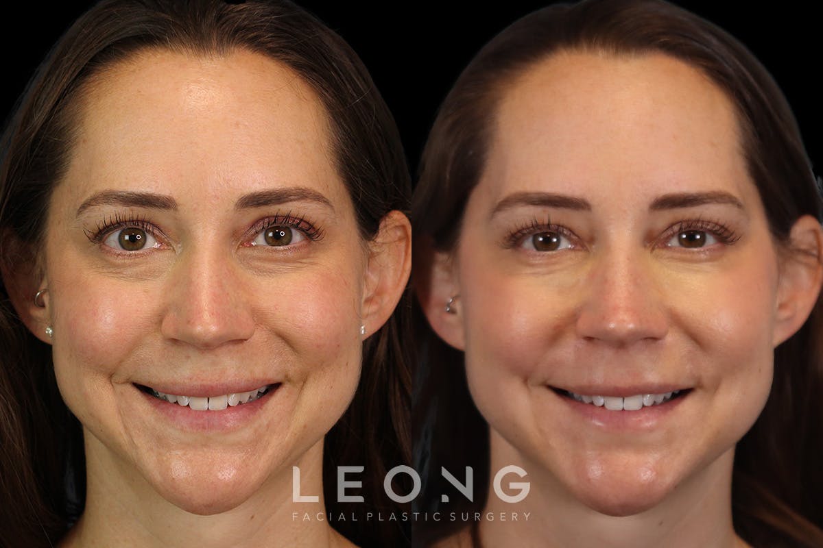 Tear Trough Correction Before & After Gallery - Patient 263355 - Image 2