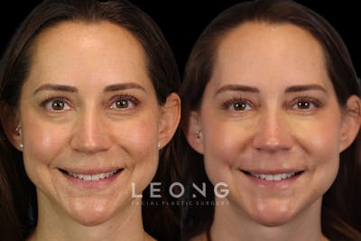 Tear Trough Correction Before & After Gallery - Patient 263355 - Image 2