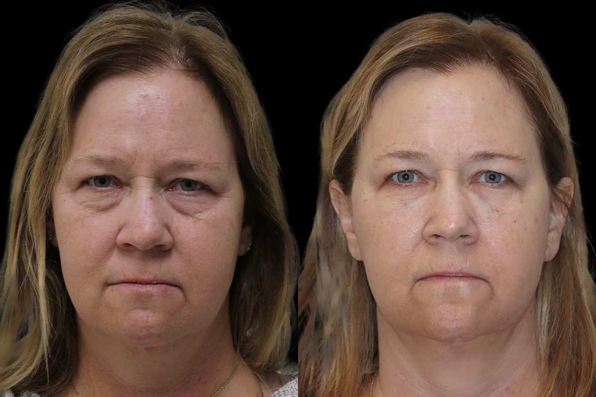 Tear Trough Correction Before & After Gallery - Patient 378245 - Image 1