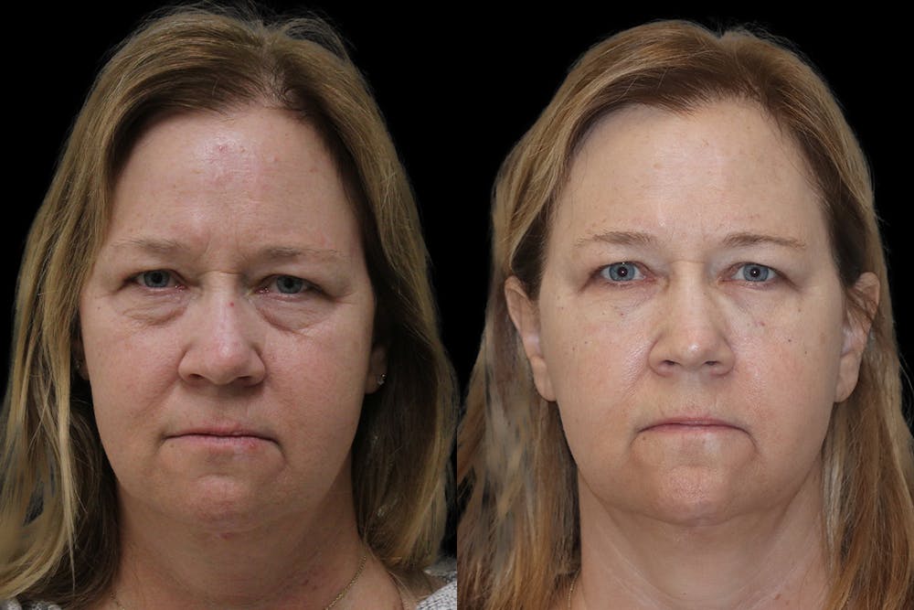 Tear Trough Correction Before & After Gallery - Patient 378245 - Image 1