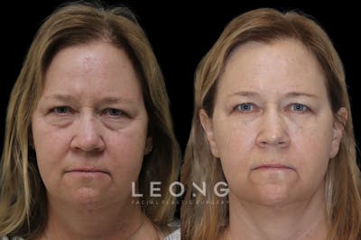 Tear Trough Correction Before & After Gallery - Patient 378245 - Image 1