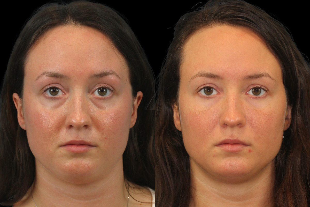 Tear Trough Correction Before & After Gallery - Patient 205385 - Image 1