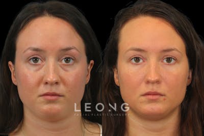 Tear Trough Correction Before & After Gallery - Patient 205385 - Image 1