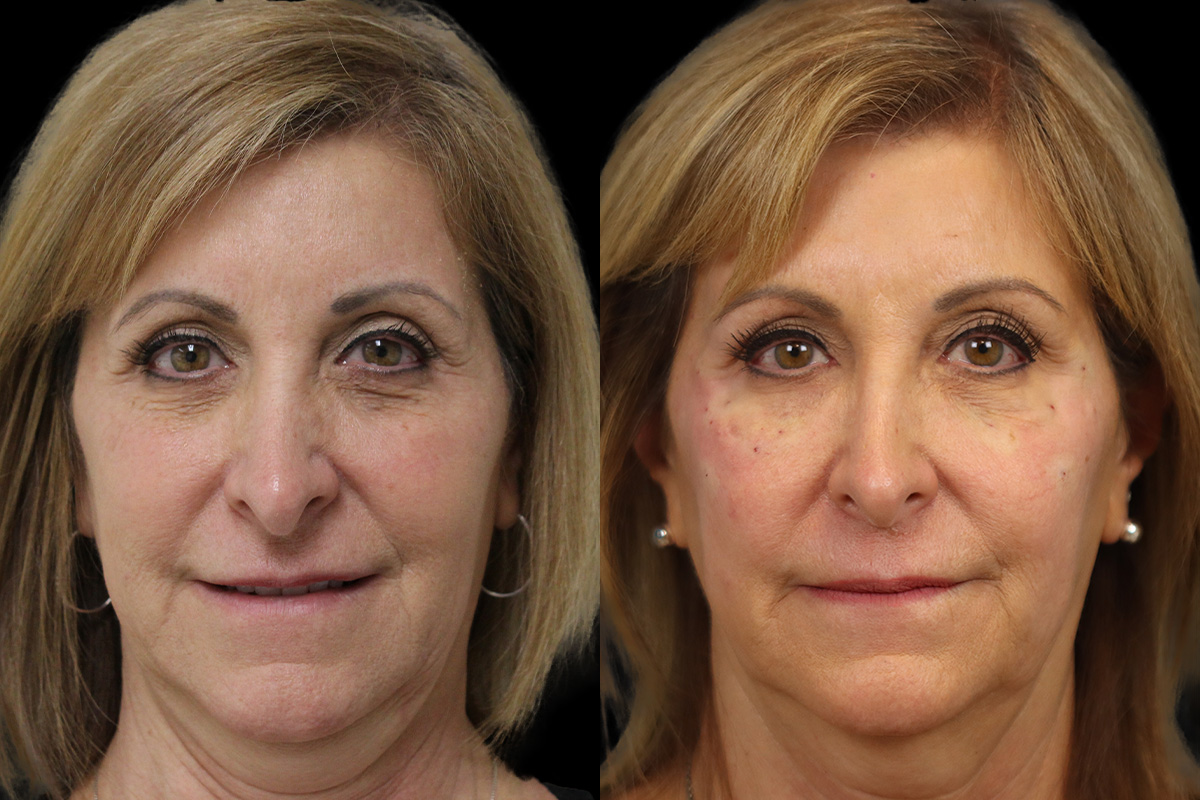 Tear Trough Correction Before & After Gallery - Patient 754716 - Image 1