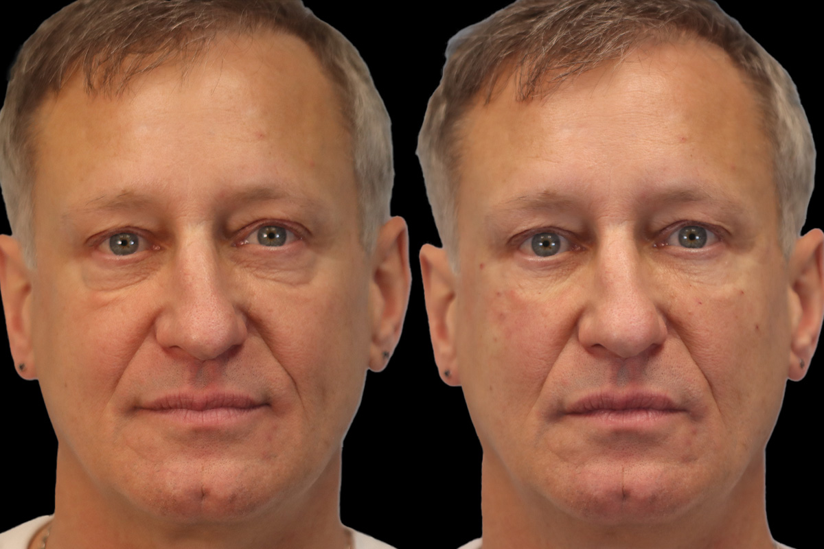 Tear Trough Correction Before & After Gallery - Patient 126802 - Image 1