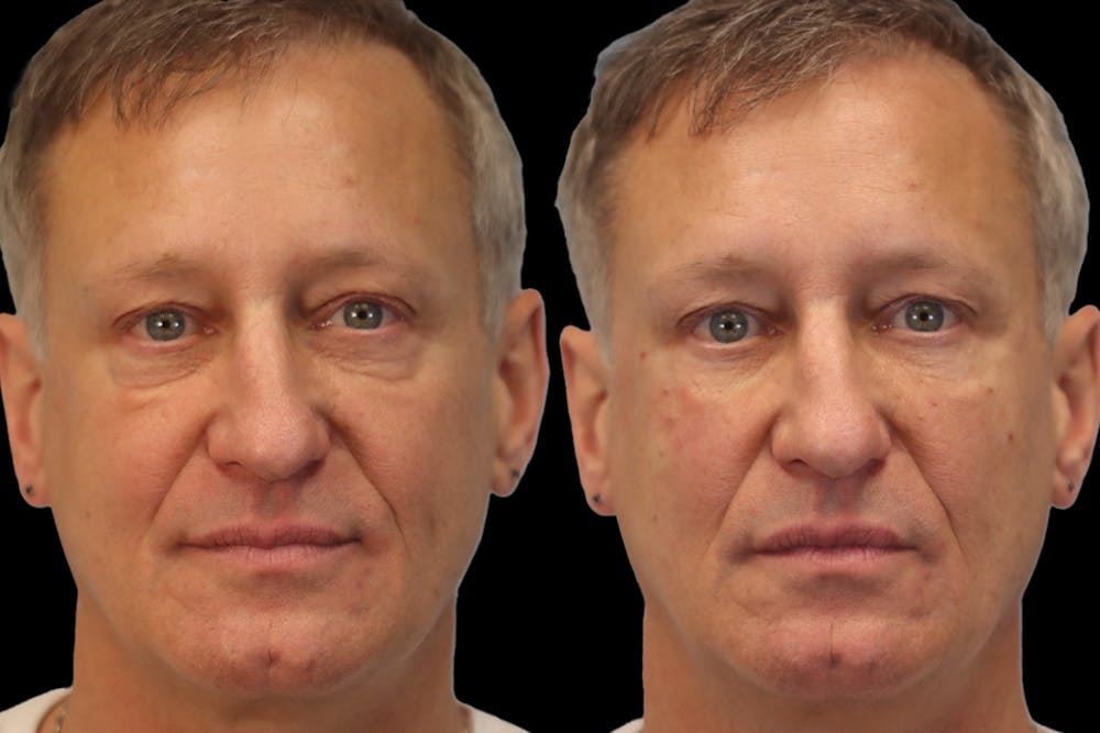 Tear Trough Correction Before & After Gallery - Patient 126802 - Image 1