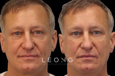 Tear Trough Correction Before & After Gallery - Patient 126802 - Image 1