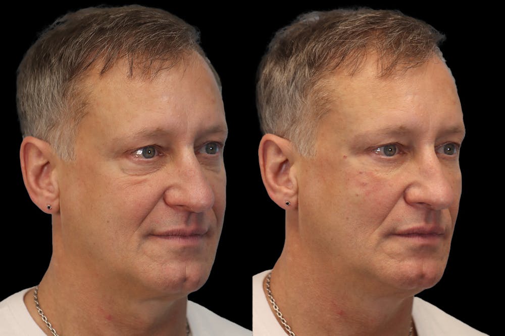 Tear Trough Correction Before & After Gallery - Patient 126802 - Image 2