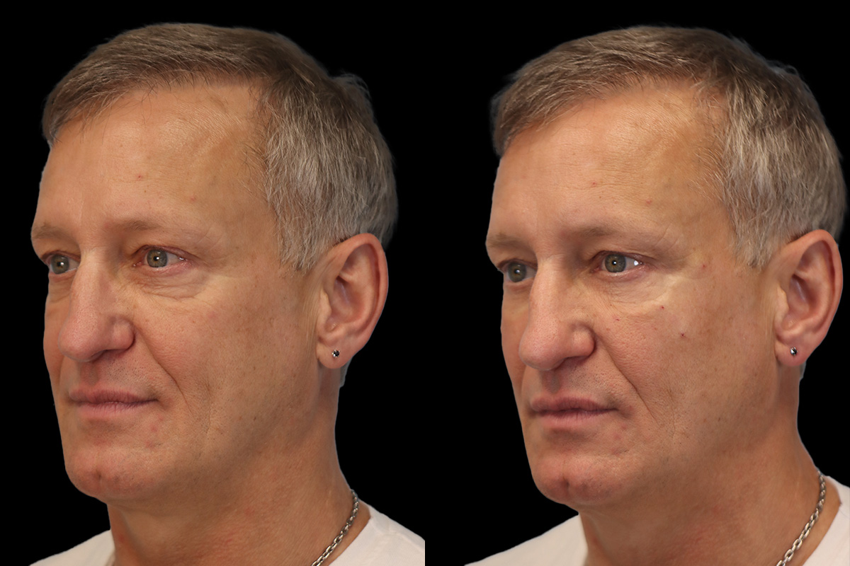 Tear Trough Correction Before & After Gallery - Patient 126802 - Image 3