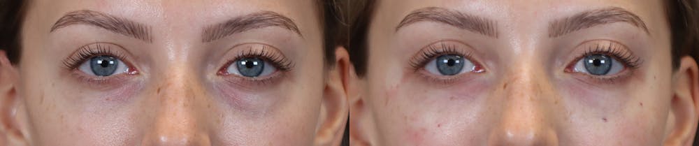 Tear Trough Correction Before & After Gallery - Patient 153553 - Image 1