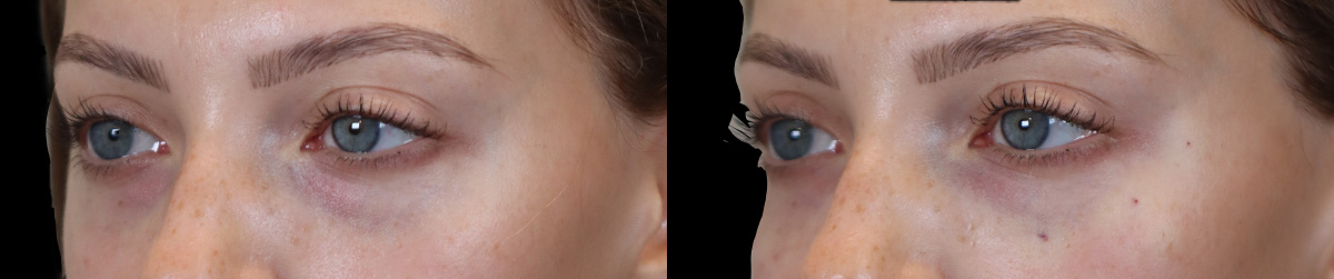 Tear Trough Correction Before & After Gallery - Patient 153553 - Image 2