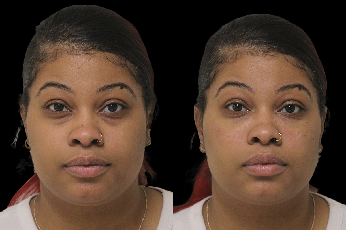 Tear Trough Correction Before & After Gallery - Patient 332540 - Image 1
