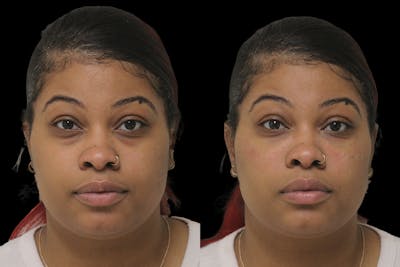 Tear Trough Correction Before & After Gallery - Patient 332540 - Image 1