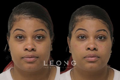 Tear Trough Correction Before & After Gallery - Patient 332540 - Image 1