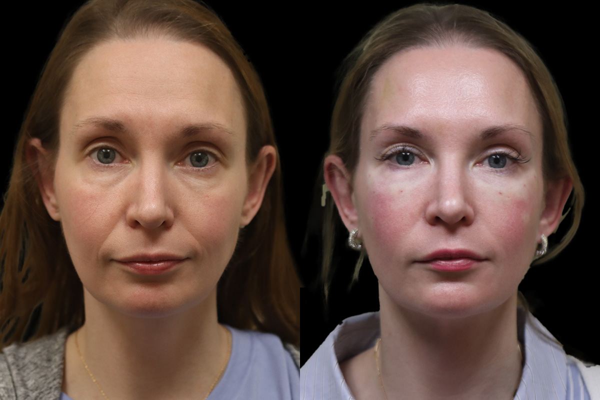 Tear Trough Correction Before & After Gallery - Patient 258858 - Image 1